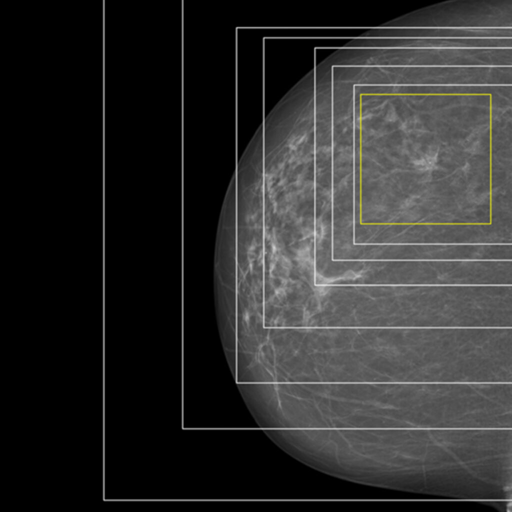Mammografibilde der et dypt nevralt nettverk har identifisert kreft, med forklarbar kunstig intelligens som fremhever området med funn.