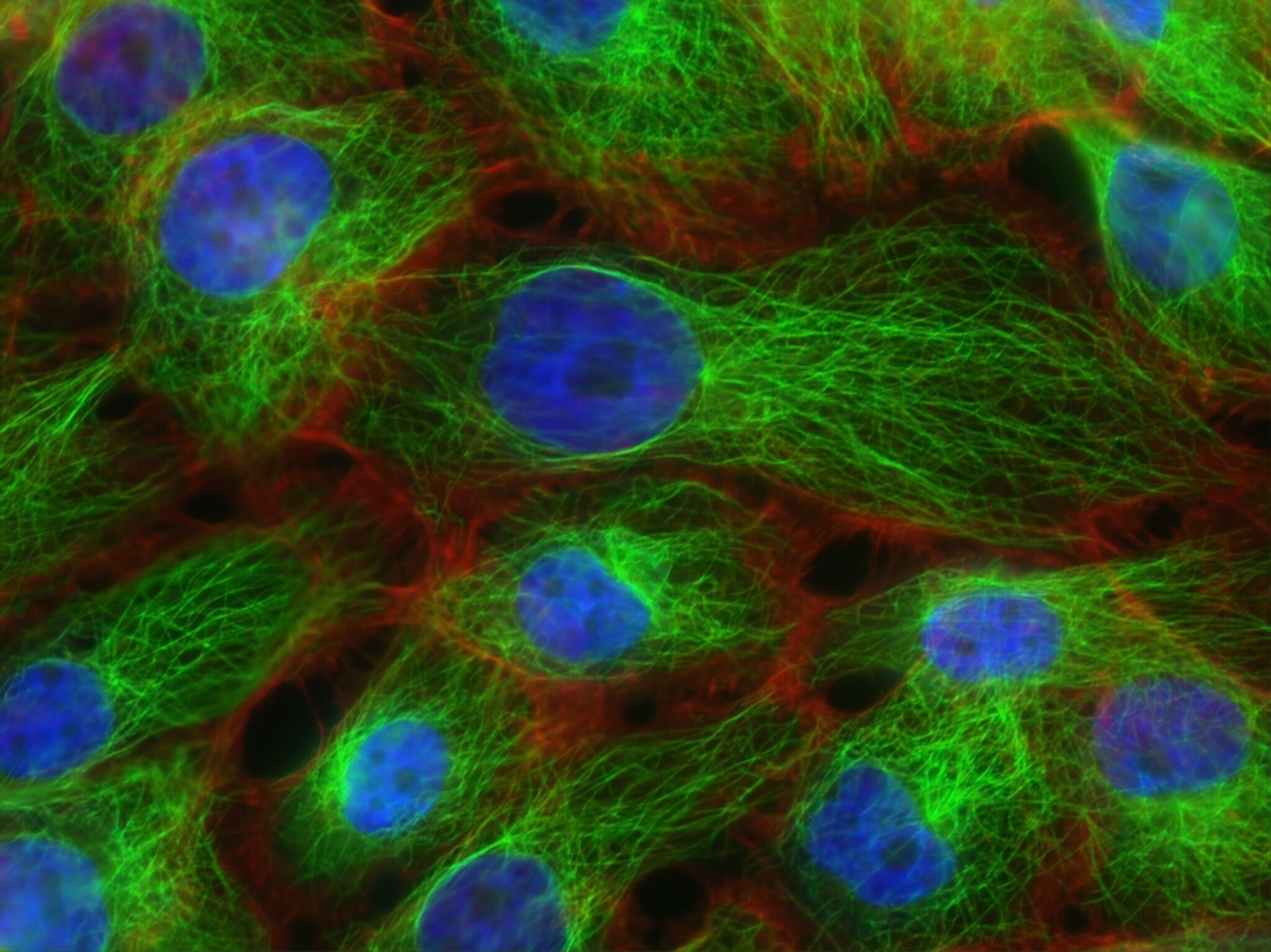 The image shows stress fibres and microtubules in human breast cancer. Image by: Christina Stuelten, Carole Parent, 2011