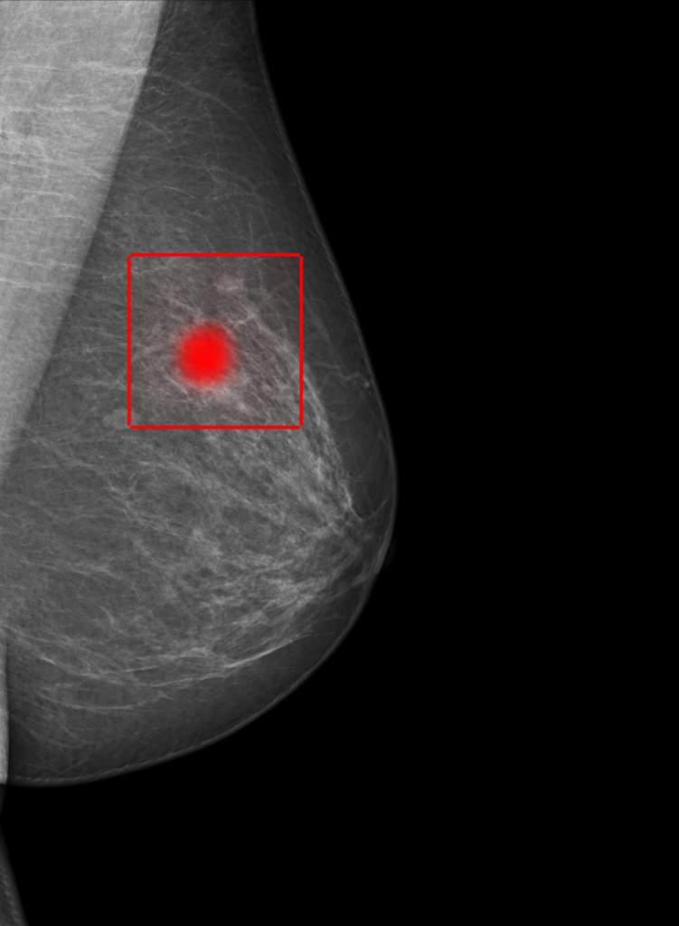 This is an x-ray image of a breast. Breast tissue is visible in the breast and a possible cancerous area is located with a red dot and a red square around it.