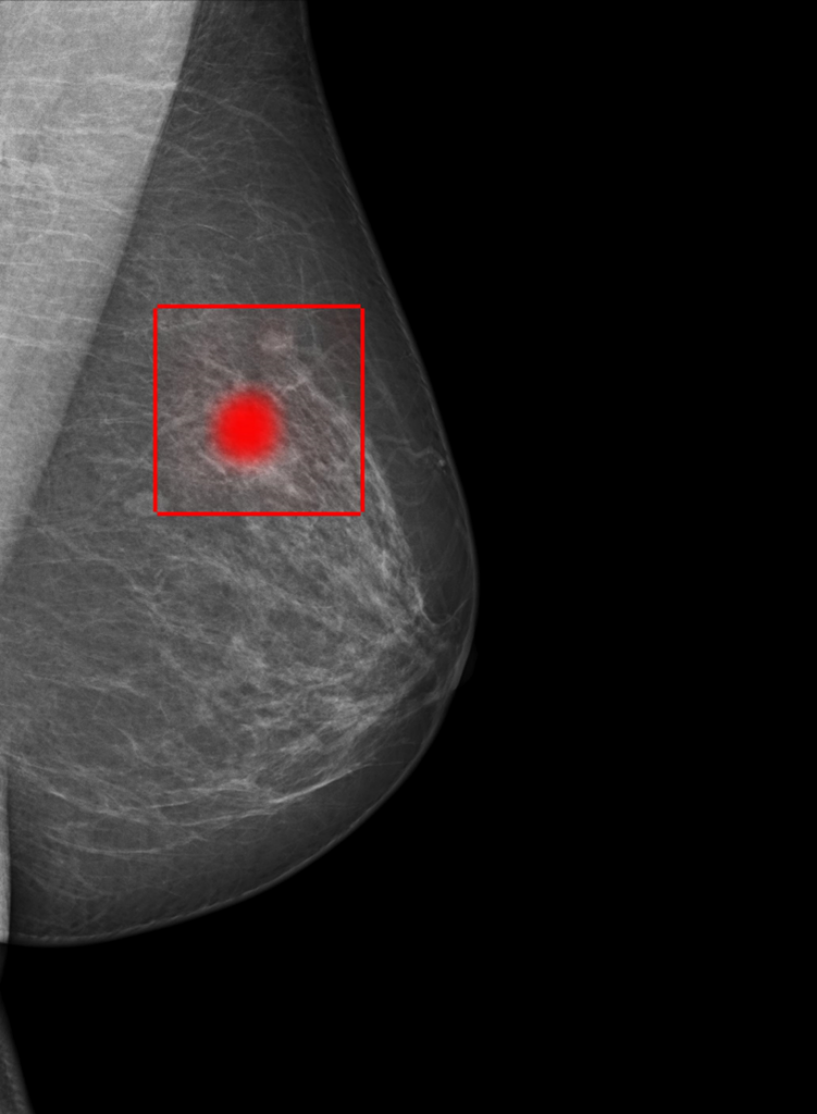 the image shows a mammogram of a breast. An area with a potential sign of illness is boxed off an marked in red.