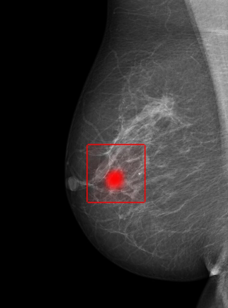 The image shows an x-ray of a breast in black, white and grey tones. The breast tissue is shown in white. A potential sign of cancer is located in a red box and further pinpointed with a red dot. 